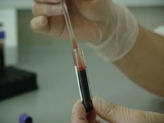  Un test de sânge, detector de anomalii genetice la făt, descoperă cancerul la viitoarea mamă 