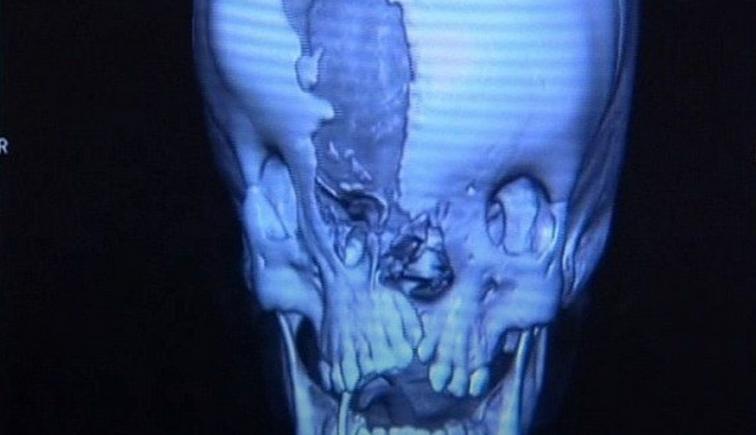 Medicii australieni au reuşit să repare faţa unui copil venit pe lume fără nas, ochi şi maxilarul superior (VIDEO)